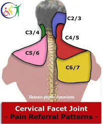 Facet joint irritation is a common cause of neck and arm pain. Hasnain Physio Associates Home Facebook