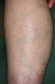 You may have other symptoms depending on what is causing your purpura. Unilateral Lower Leg Purpura