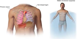 Parsonage-Turner Syndrome and Hereditary Brachial Plexus Neuropathy - Mayo  Clinic Proceedings