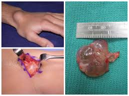 Image result for Cyst