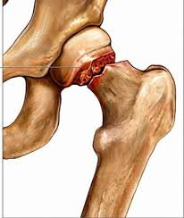 GÃY CỔ XƯƠNG ĐÙI - Bệnh Viện Quân y 7A