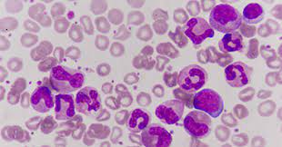 In leukemia and myelodysplastic syndromes (mds), the bone marrow (the inner, spongy part of large bones) can become filled with cancer cells, which can cause bone or joint pain. Difference Between Blood Cancers Leukemia Lymphoma Ctca