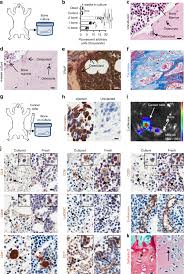 Stem cell transplants, also called bone marrow transplants, can treat certain blood cancers. The Cxcl5 Cxcr2 Axis Is Sufficient To Promote Breast Cancer Colonization During Bone Metastasis Nature Communications