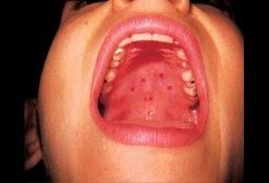 A bundle of muscles extends from the floor of the mouth to form the tongue. Why Is The Roof Of My Mouth Yellow With Red Dots My Throat Is Also Sore Quora