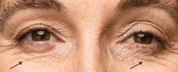 Scrapings from the inner eyelid surfaces, about the vaccine trial, and. Getting Rid Of Under Eye Wrinkles Anti Wrinkle Injections Dermal Fillers Or Leave Them Alone Cityskin Cosmetic Clinic