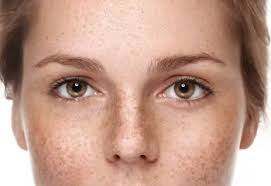 Image result for Freckles