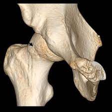 Der kostenlose service von google übersetzt in sekundenschnelle wörter, sätze und webseiten zwischen deutsch und über 100 anderen sprachen. New Surgery For Groin Pain Found To Be More Effective Than Physiotherapy Eurekalert Science News