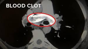 If the clot is in your arms or legs, you may experience pain (that feels like an. Why Are So Many Covid 19 Patients Also Seeing Blood Clots Abc News