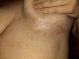 Image result for Candidiasis under breasts