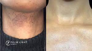 At young ldn you have the opportunity to tailor make a bespoke treatment plan that is as individual as you and your concerns are. Pcos Laser Hair Removal Pulse Light Clinic London