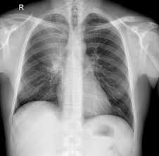 Atelectasis is a lung condition that happens when your airways or the tiny sacs at the end of them don't expand the way they should when you breathe. Right Upper Lobe Collapse Radiology Reference Article Radiopaedia Org