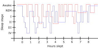 Image result for Restless Leg Syndrome