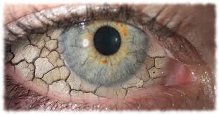 Image result for Dry Eye