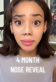 Hailey Sani Before and After Nose