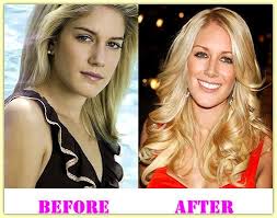 Pin On Celebrities Plastic Surgery Before And After