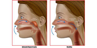 Image result for Sleep Apnea