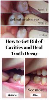Pin By Mike On Natural Cures Heal Cavities Teeth Health Dental Cavities