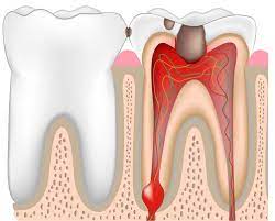 How Dangerous Is An Infected Tooth?