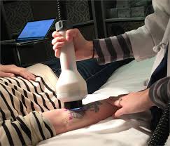 He visits maria d's for a gyro, takes multiple visits to federal hill park, and watches the 4th of july fireworks. Increased Tattoo Fading In A Single Laser Tattoo Removal Session Enabled By A Rapid Acoustic Pulse Device A Prospective Clinical Trial Kaminer 2020 Lasers In Surgery And Medicine Wiley Online Library