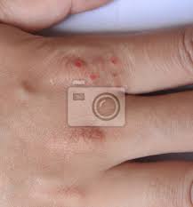 Vi erbjuder ett gedigen utbud av produkter för att hantera åkomman i fråga. Inflammation I Huden Pa Handerna Torra Hudutslag Och Klada Fototapet Fototapeter Omhet Dermatit Rodnad Myloview Se