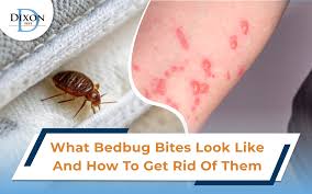 Image result for bedbugs bites