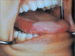 There are three types of biopsies, according to the american cancer society. Erythematous Oral Lesions When To Treat When To Leave Alone Consultant360