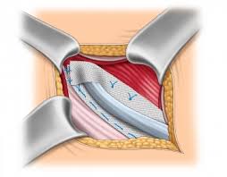 We did not find results for: Lichtenstein Repair Of Inguinal Hernia