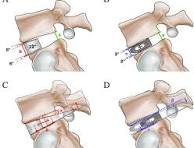 Cage position in OLIF (A, C) and PLIF (B, D). (A, B) When ...