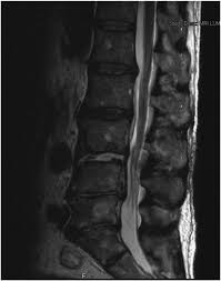 Image result for Spinal Epidural Abscess