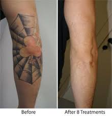 Luminous dermatology is a trusted provider of laser treatment options to help patients in santa barbara and santa maria, ca, look and feel their best. Evolutions February Event Tattoo Removal And Laser Hair Removal Evolutions Medical Day Spa In Santa Barbara Best Of Indy Winner 2019