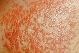 The groin includes the pelvis and reproductive organs, as well as. Rashes Bumps And Lumps Below The Belt