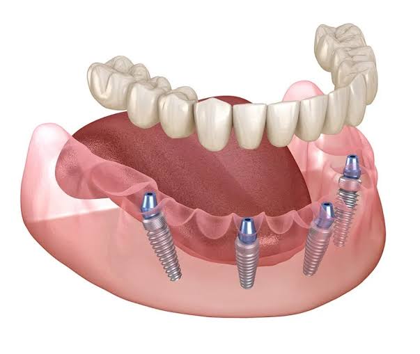 full mouth implants