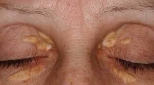 How To Prevent High Cholesterol From Destroying Your Health By Pene Hodge Beingwell Medium