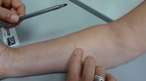 Maybe you would like to learn more about one of these? Tb Skin Test Read Youtube