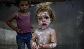 Image result for scabies human children