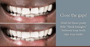 Maybe you would like to learn more about one of these? Bioclear Saves You Money Time And Discomfort Giesy Family Implant Dentistry