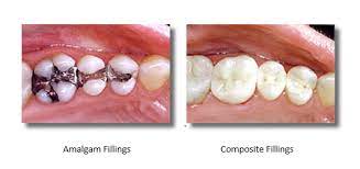 If left untreated, a cavity will get worse and could lead to increased discomfort in the affected tooth. Pain After White Filling The Blog Of Sherwood Dental Care