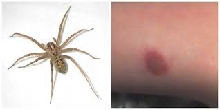 Image result for wolf spider bite skin