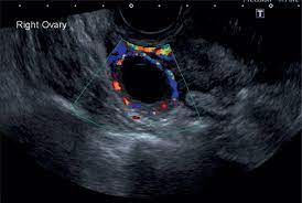 This is when a big cyst causes an ovary to twist nevertheless, symptoms of ovarian cancer can mimic symptoms of an ovarian cyst. Sonographic Assessment Of Ovarian Cysts And Masses Chapter 8 Gynaecological Ultrasound Scanning