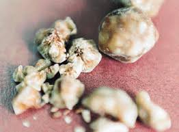 See more of obat batu karang ginjal dan empedu on facebook. Diagnosis Penyakit Batu Karang Hempedu Sembang Ilmiah Bukan Sekadar Sembang