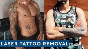 We don't charge per square inch, per local, location on the body and can even treat two or three smaller tattoos at one office visit, for no added cost. Laser Tattoo Removal Full Arm Tattoo Update After 3 Treatments Youtube