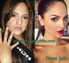 We did not find results for: Eiza Gonzalez Plastic Surgery Before And After Plastic Surgery Celebrity Plastic Surgery Rhinoplasty
