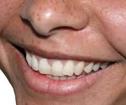 A permanent retainer consists of a thin, strong wire attached to the back of each. How To Remove Plaque From A Permanent Retainer How To Clean Stuff Net