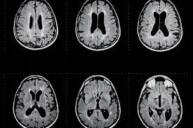 It damages the myelin sheath, the material that surrounds and protects your nerve cells. A New Culprit For Multiple Sclerosis Relapses Uconn Today