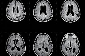 Multiple sclerosis (ms) is an autoimmune disease in which the body's immune system attacks its own central nervous system (the brain and spinal cord). A New Culprit For Multiple Sclerosis Relapses Uconn Today