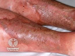 Image result for Lipodermatosclerosis