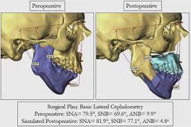 Orthodontic And Surgical Management Of A Patient With Severe Mandibular Deficiency And Asymmetry With Condylar Hypoplasia Using 3 Dimensional Surgical Planning In Combination With A Modified Surgery First Approach Sciencedirect