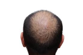 Eventually the hair becomes thinner and shorter, and creates a horseshoe pattern around the sides of the head. Hair Loss In Men Boss Clinic