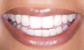 Your body can strengthen weak enamel itself if you eat fortifying foods. Best Home Teeth Whitening Kit How To Whiten Teeth Express Co Uk