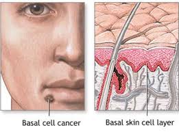 By Oliver Pichay Our Lady Of Fatima University Acne Acne Is A Skin Disease Marked By Pimples On The Face Basal Cell Carcinoma Basal Cell Integumentary System